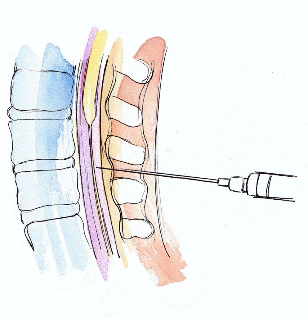 Illustration Medical Spinal Injection Vertebrae Line Wash