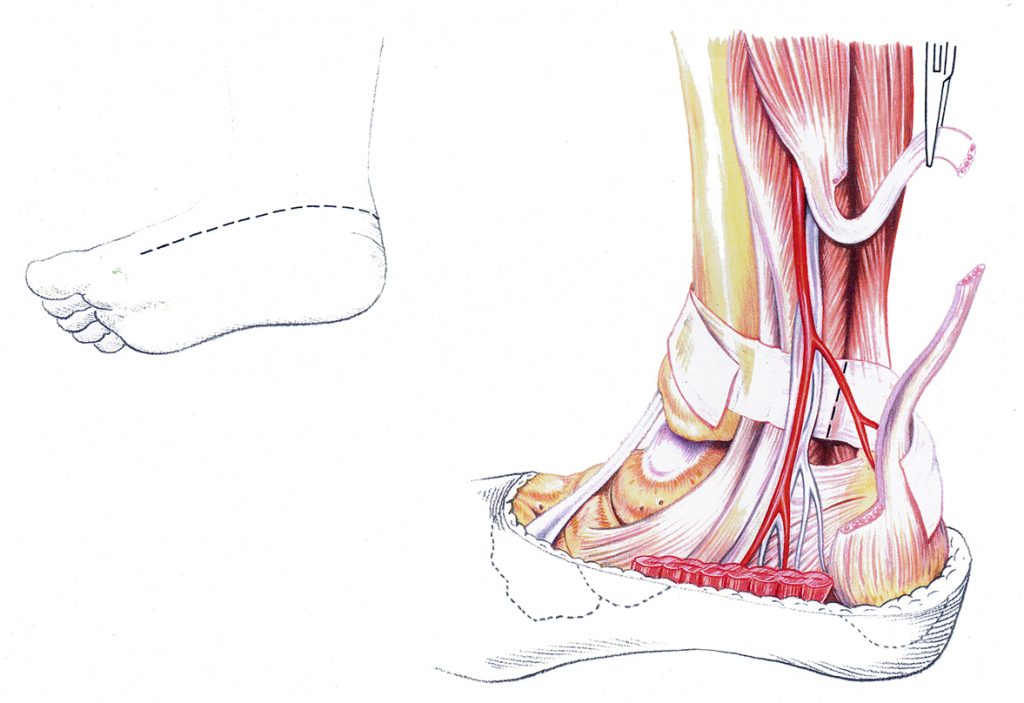 Illustration Medical Lengthening Achilles Tendon Telipes Operation